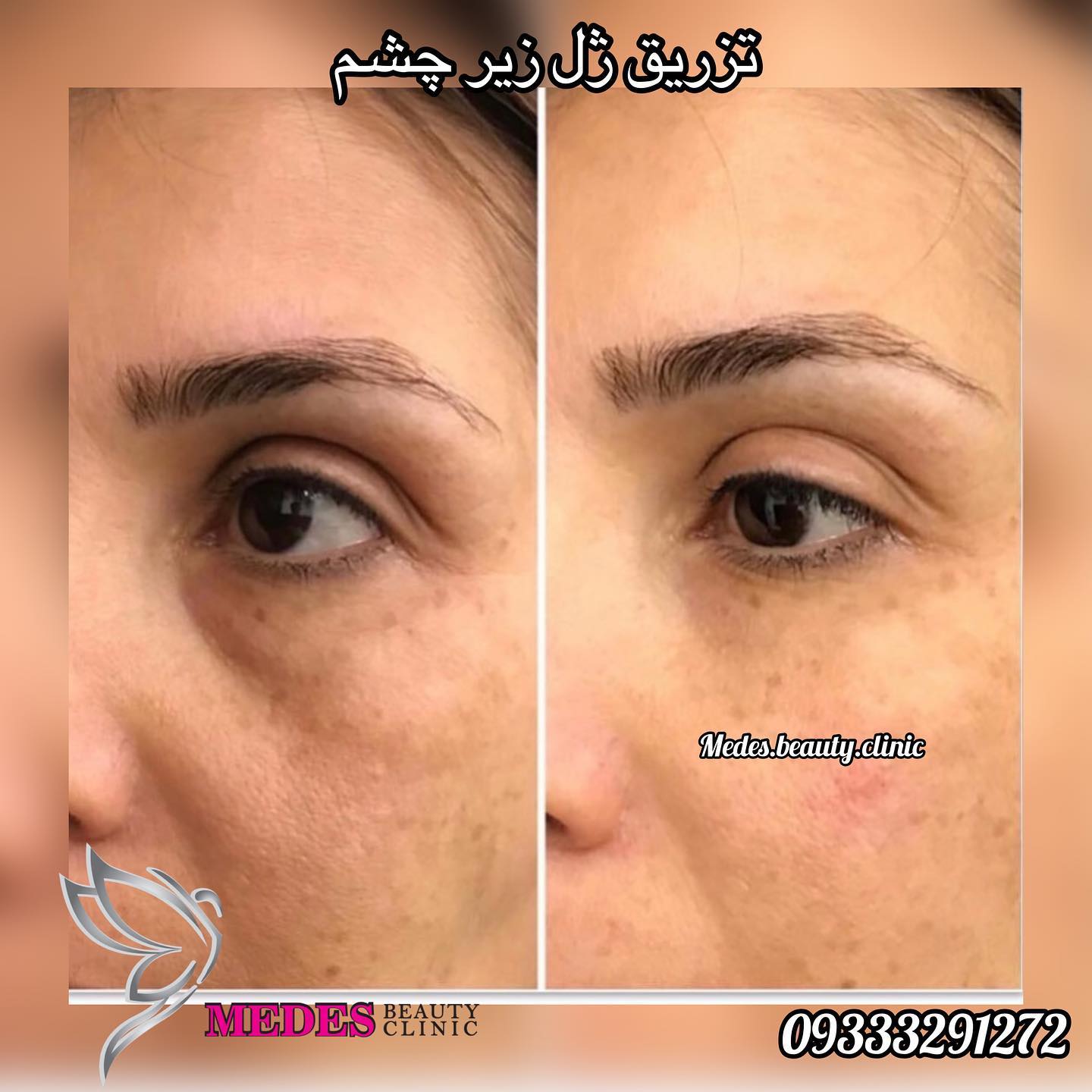 گالری فیلر زیر چشم